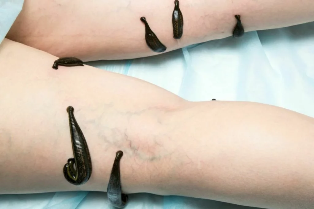 ฝันว่าปลิงเกาะขา